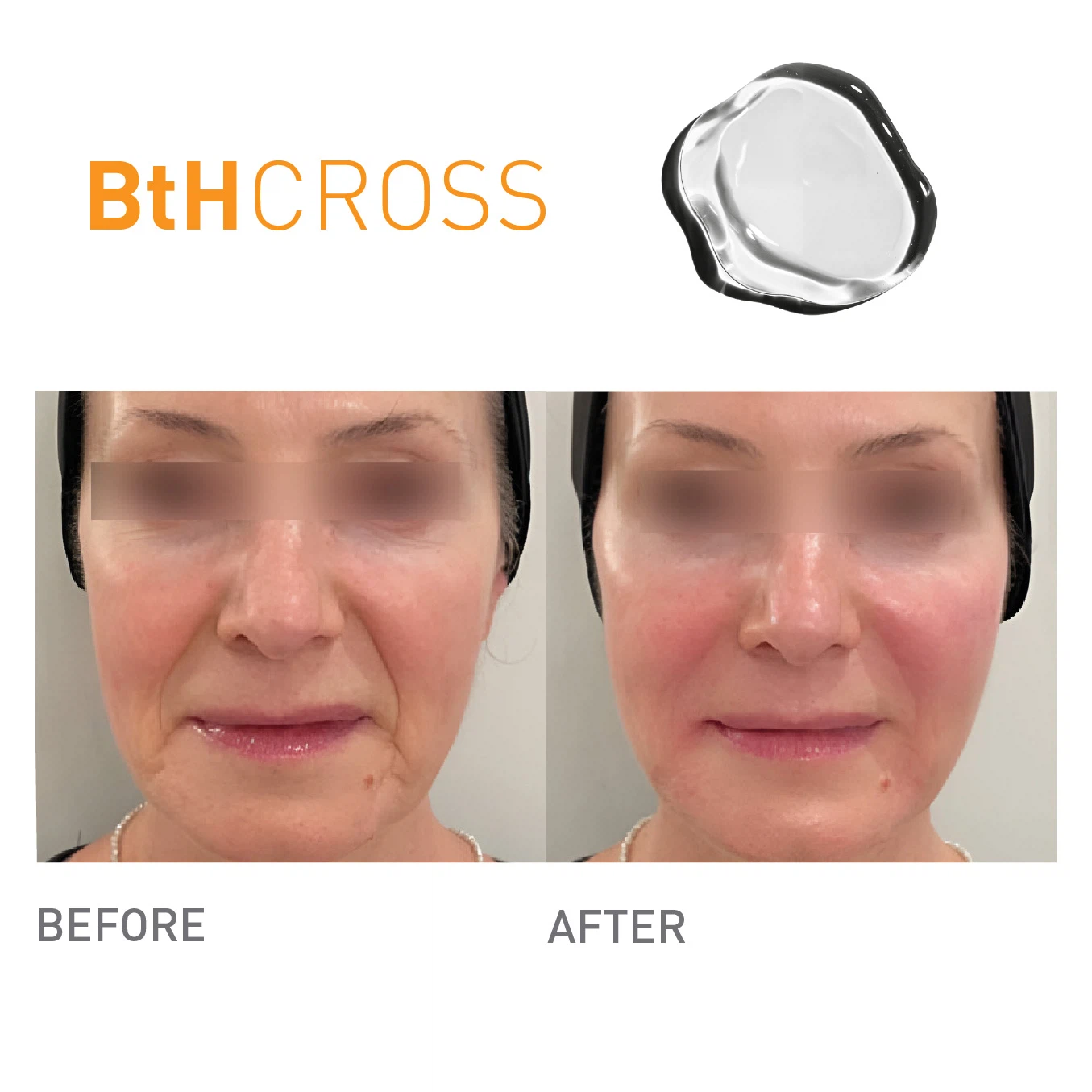 Bthcross 1 75 before after results product image