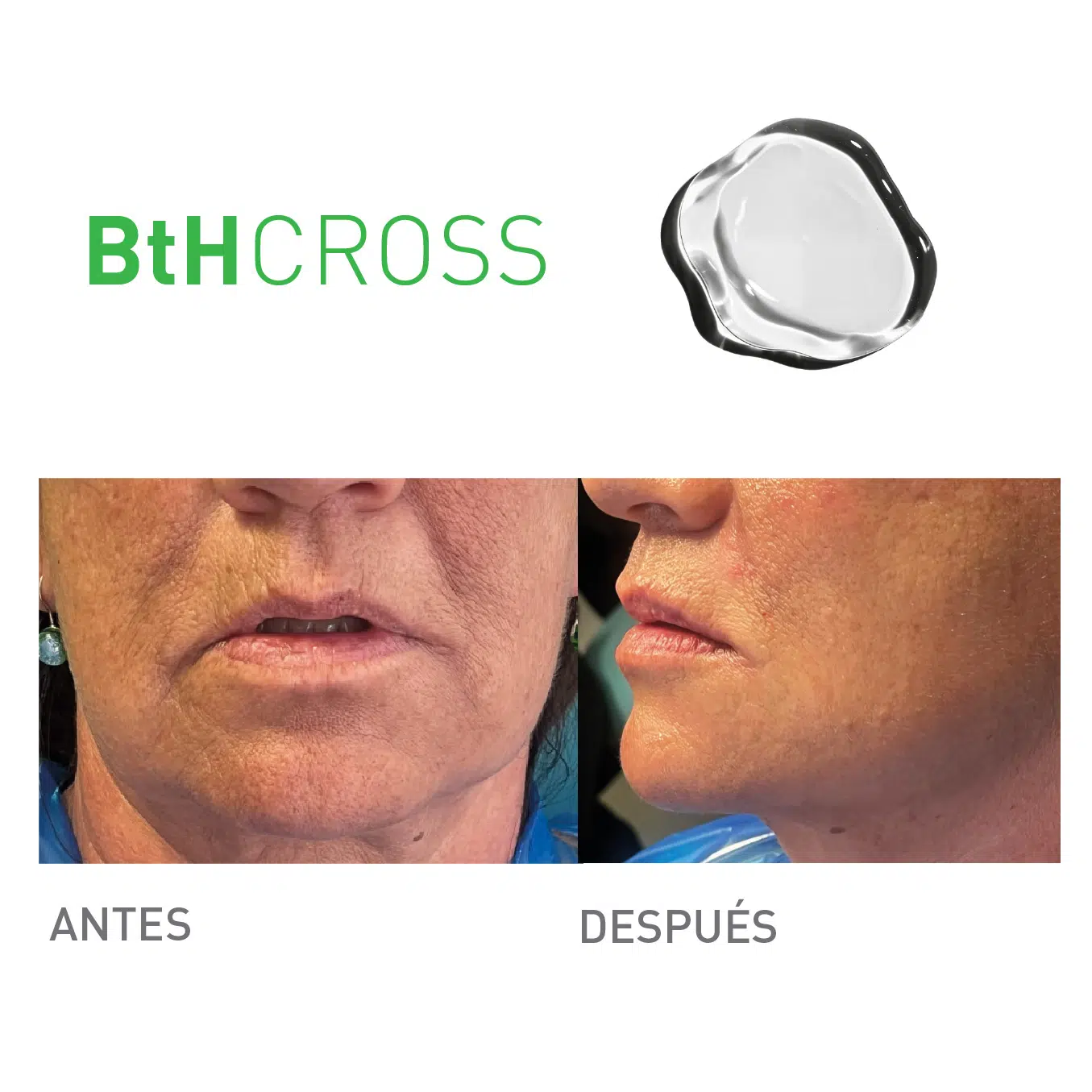 Imagen de Bthcross 2 0 resultados antes despues